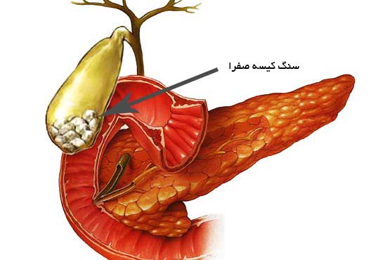 سنگ کیسه صفرا