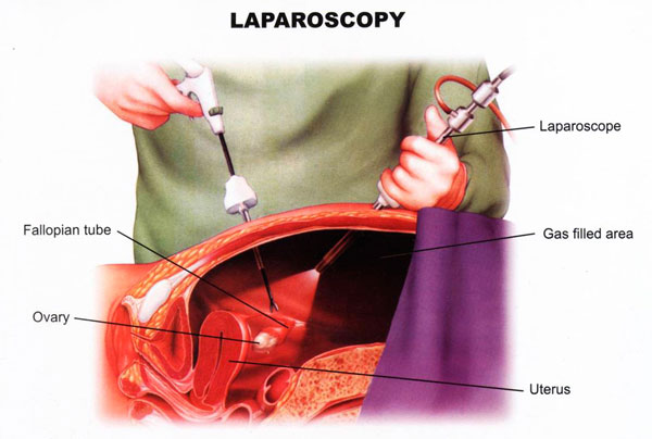 جراحی لاپاراسکوپی
